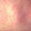 الحصبة 