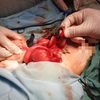 إجراء جراحة لطفلة بمستشفى ميت غمر 