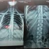 ابتلاع دبوس 