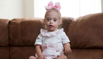 طفلة مصابة بمتلازمة