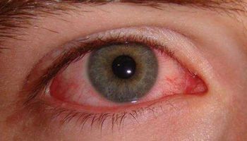 ما أسباب التهاب ملتحمة العين لدى الطفل؟