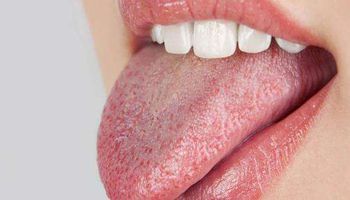 ما أسباب جفاف الفم؟