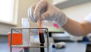 الصحة " توزيع أجهزة لفصل بلازما الدم في أقاليم مختلفة" 