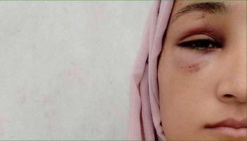 ولاء السطري كانت على وشك فقدان عينها حسب روايتها