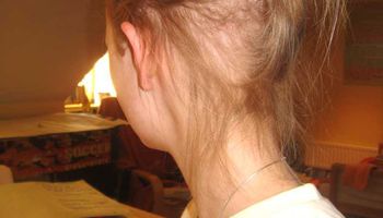  علاجات منزلية لنمو الشعر على بقع الصلع 