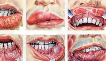 أسباب سرطان الفم.