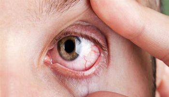 مرض كوست,, شبكية العين
