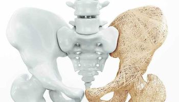 مرضى هشاشة العظام أكثر عُرضة لكسر عنق الفخذ
