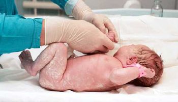 تقشير الجلد للأطفال حديثي الولادة