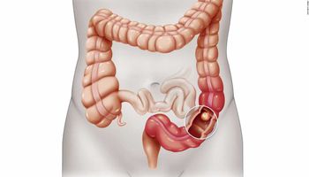 الأطعمة التي يجب أن يتجنبها المصاب بسرطان القولون