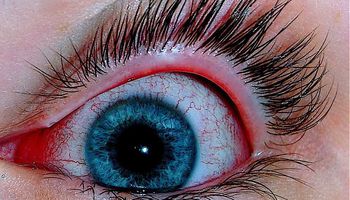  علاجات طبيعية  لالتهابات العين