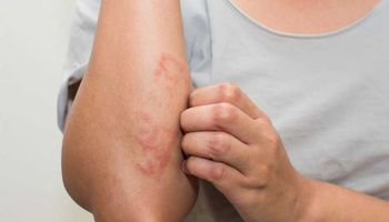 أنواع حساسية الجلد وأسبابها وطرق علاجها 