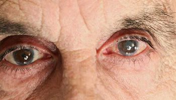 أمراض العيون - صورة أرشيفية
