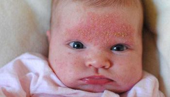 علام تدل البقع الجلدية الحمراء لدى الأطفال؟
