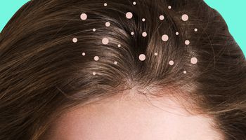 علاجات طبيعية تخلصك من قشرة الشعر في الشتاء 