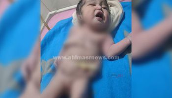 طفل مولود بدون بطن في الأقصر 