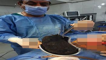 استخراج 3 كيلو شعر من معدة 