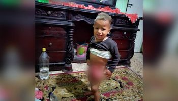 انفجار أمعاء طفل أبو حمص 