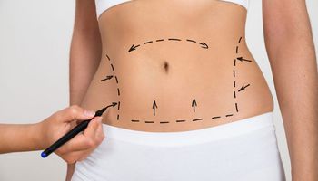 أنواع عمليات  شفط الدهون 