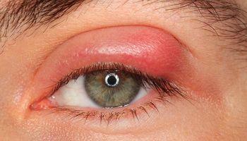 التهاب العيون فيروس كورونا 