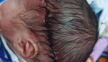 إصابة طفل حديث الولادة بقطع فى الرأس أثناء إجراء ولادة قيصرية 