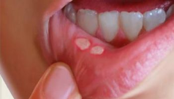أمراض الفم