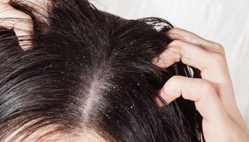علاج القشرة في الشعر 