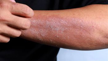 أمراض جلدية في فصل الصيف