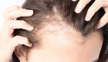 وصفات لإنبات الشعر