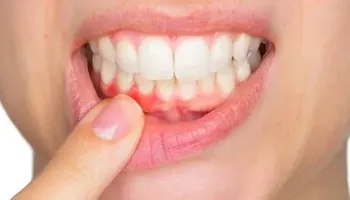 ألم الأسنان 