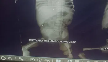 جانب من إجراء الجراحه 