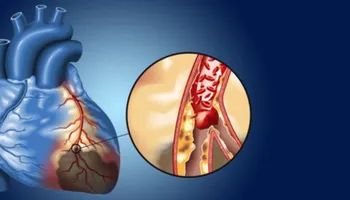 علاج انسداد الشرايين