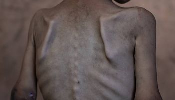عظام طفل من غز برزت بسبب الجوع