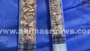 استخراج حصاة بطول 7 سم من كلى مريض بمستشفى دسوق العام  