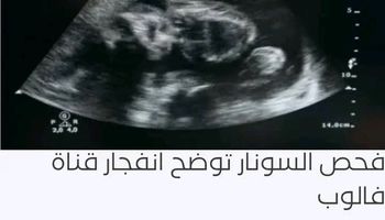 جانب من الأشعة الخاصة بالمريضة 