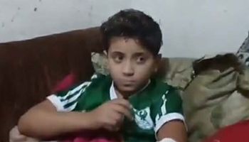 كلب شرس يعقر طفلًا في منطقة الإسراء ببورسعيد وشقيقته:معرض زراعه  للبتر