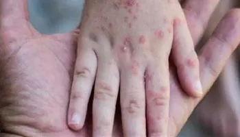 جدري القرود