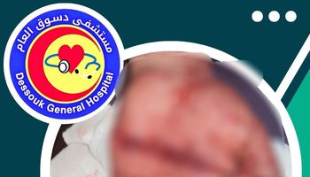 أطباء مستشفى دسوق العام ينقذون يد مريض من البتر 