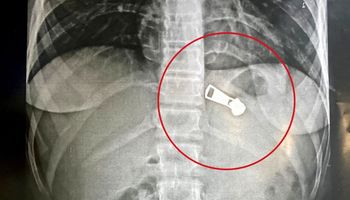 استخراج جسم معدني من معدة طفلة بمستشفى دسوق العام