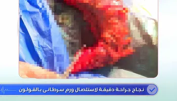 أطباء مستشفى دسوق العام ينجحون في استئصال ورم سرطانى بالقولون  لمريض