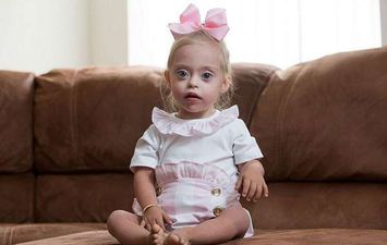 طفلة مصابة بمتلازمة