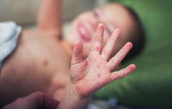 فيروس البوحمرون يهدد حياة 4 ملايين طفل في الجزائر