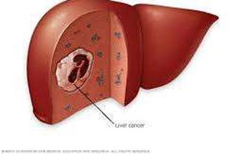  سرطان الكبد