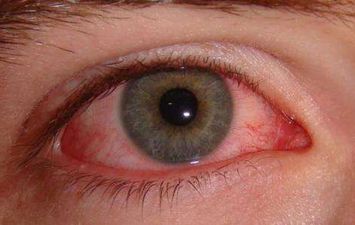 ما أسباب التهاب ملتحمة العين لدى الطفل؟