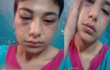 اثار الضرب علي منة عبدالعزيز 