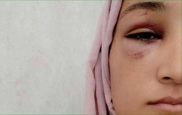 ولاء السطري كانت على وشك فقدان عينها حسب روايتها