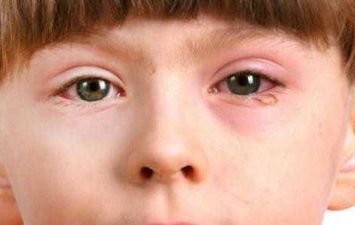 أنواع وأعراض امراض شبكية العين