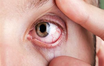 مرض كوست,, شبكية العين