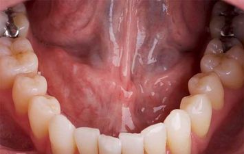 أعراض سرطان الفم والأسنان