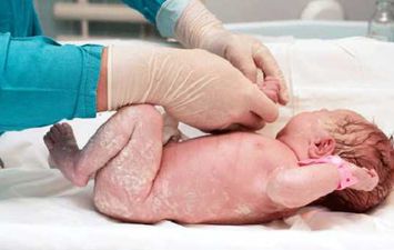 تقشير الجلد للأطفال حديثي الولادة